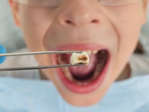 Best Emergency Dental Extractions in Orinda, CA